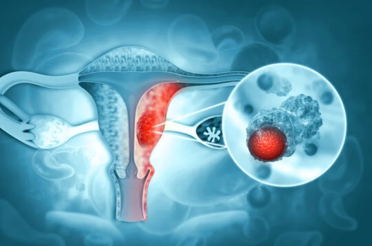 Gynecological Cancer-----0
